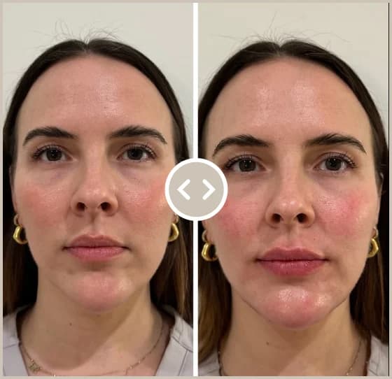 Résultat d'un traitement global du visage